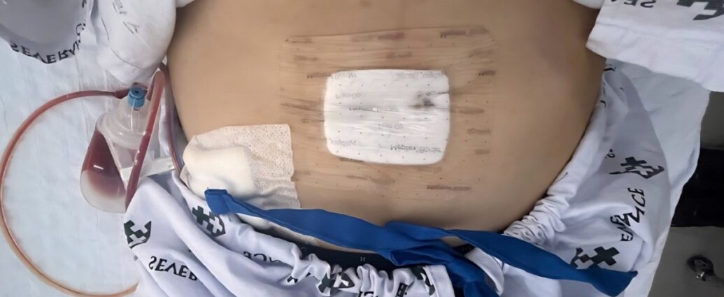 자궁근종 로봇수술 직후 복부 모습