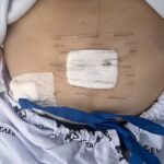 자궁근종 로봇수술 직후 복부 모습