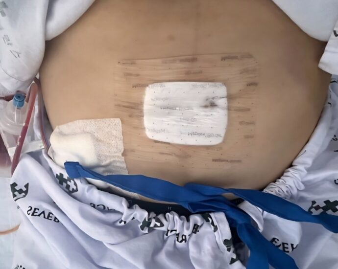 자궁근종 로봇수술 직후 복부 모습