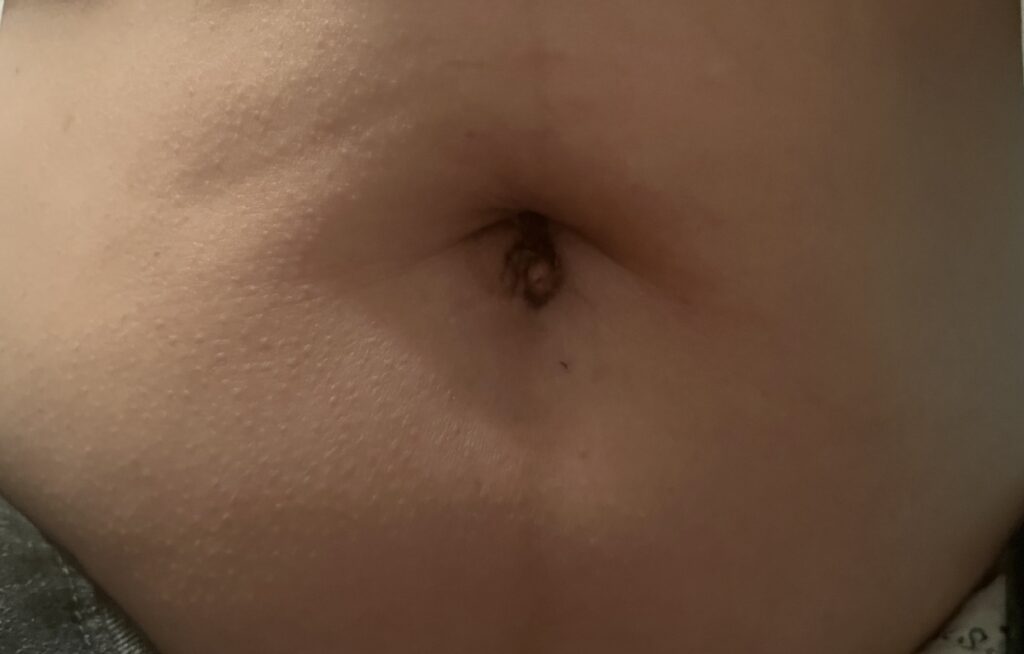 자궁근종 로봇수술 3개월 후 배꼽모양 흉터