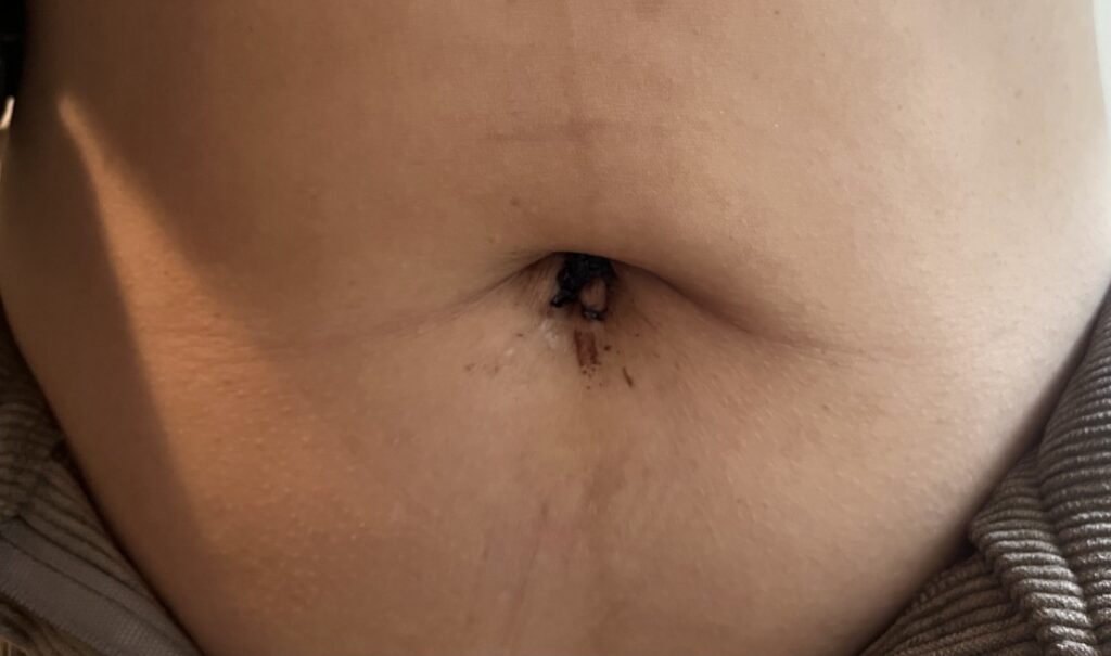 자궁근종 로봇수술 일주일 후 배꼽모양 흉터